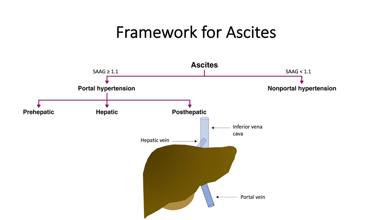 Differential Diagnosis of Ascites