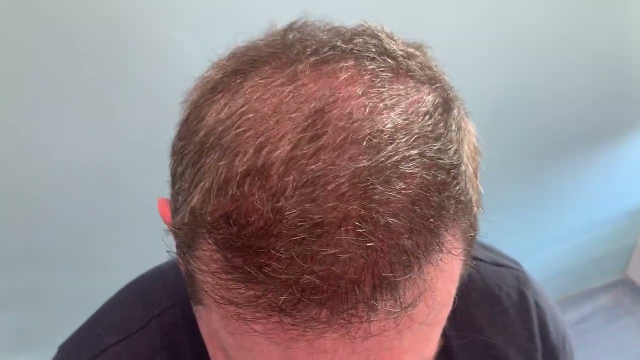 ⭐⭐ ⭐⭐⭐Case #157 - Δείτε το αποτέλεσμα με 3000 FUs - Anastasakis Hair Clinic
