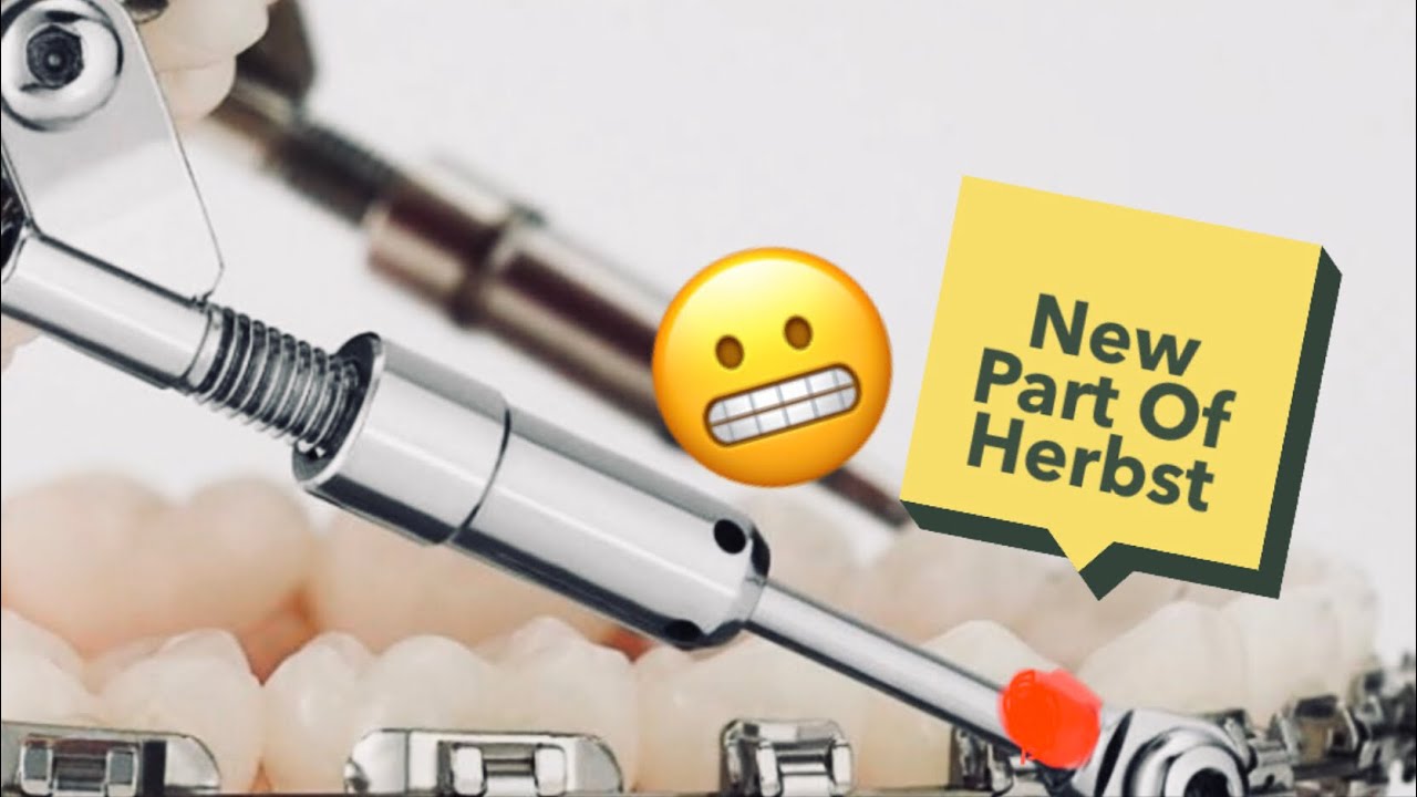 Herbst Appliance Update