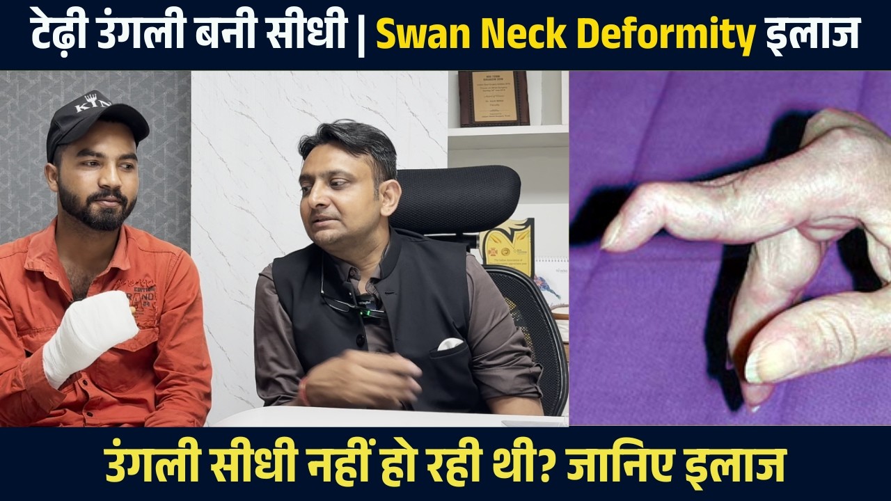 जटिल Swan Neck Deformity हुआ सही इलाज से ठीक | Swan Neck Deformity Treatment