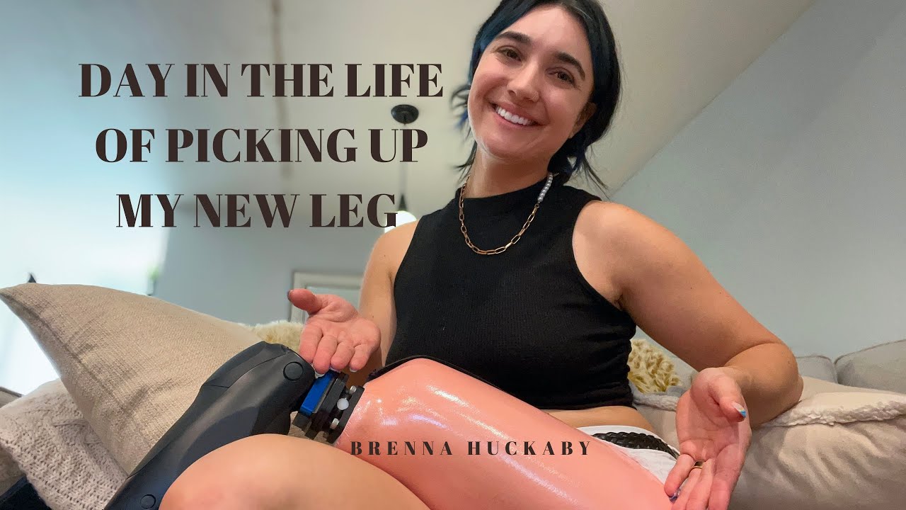 The process of getting a new leg | VLOG