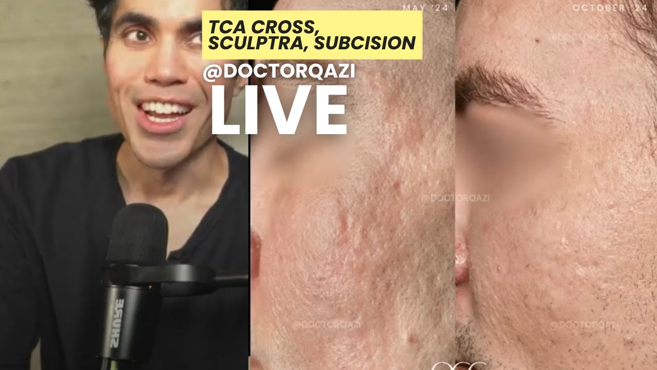 Dr. Qazi discusses TCA Cross, Sculptra, Subcision, Bellafill | Dr. Qazi Unsponsored Live | 4.3.2025