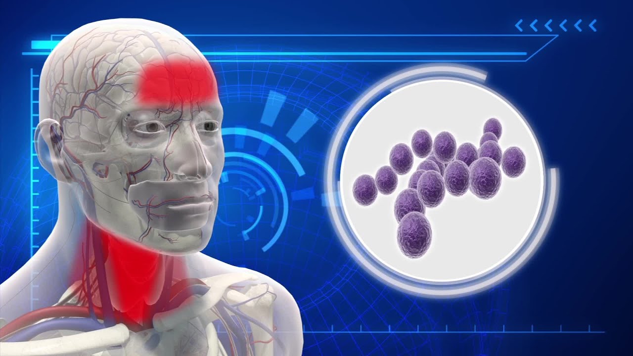 What is strep throat and how do you catch it?