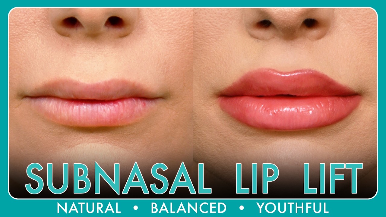 What is a Subnasal Lip Lift? Understanding Lip Lift Surgery