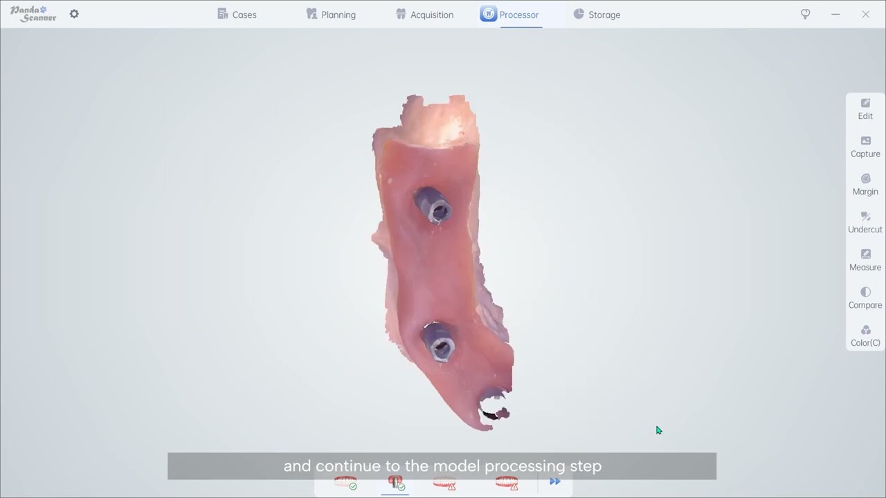 Implant-Scanning method of the scan body[1]