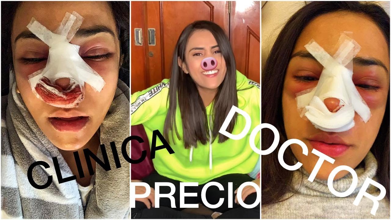 RINOPLASTIA (PRECIO, CLINICA, MEDICO) QUE ME PASO EN LA CARA! LO QUE NADIE TE CUENTA!!