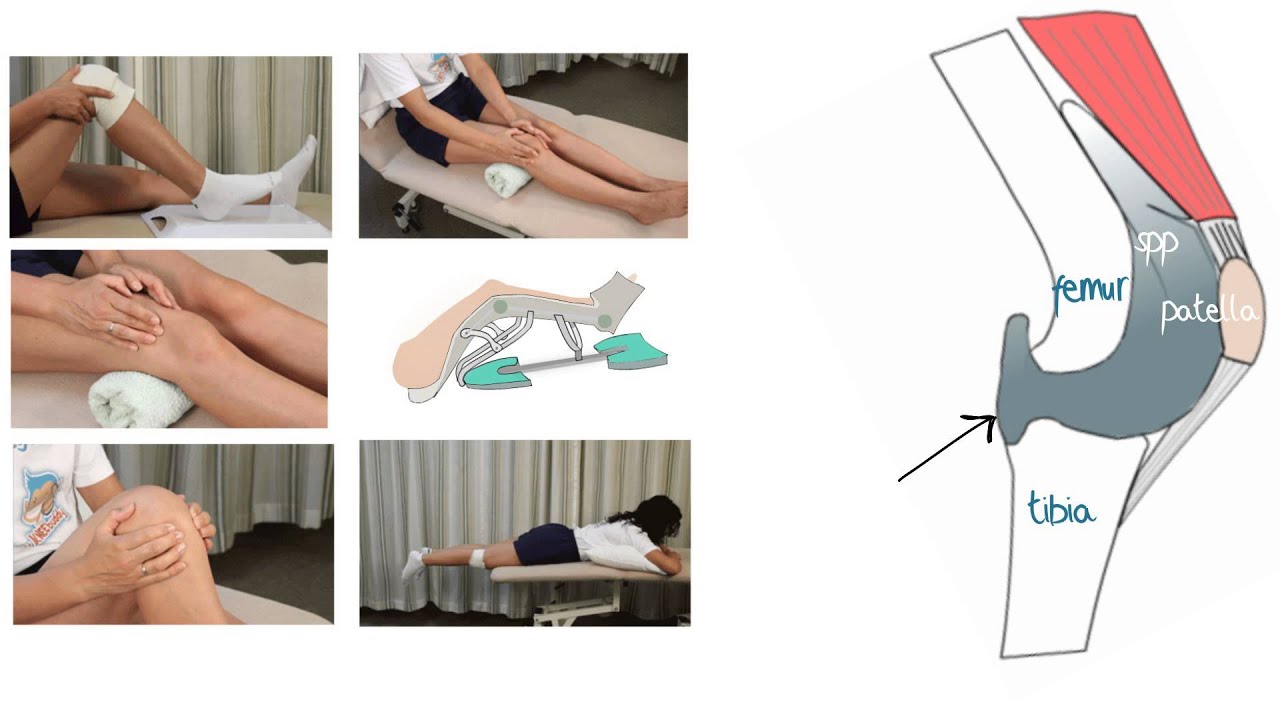 What is arthrofibrosis?