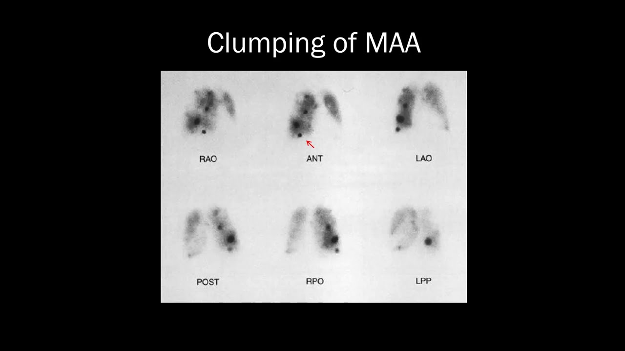 V/Q: Simplified Criteria for the On-Call Radiologist | 15 Minute Radiology CME