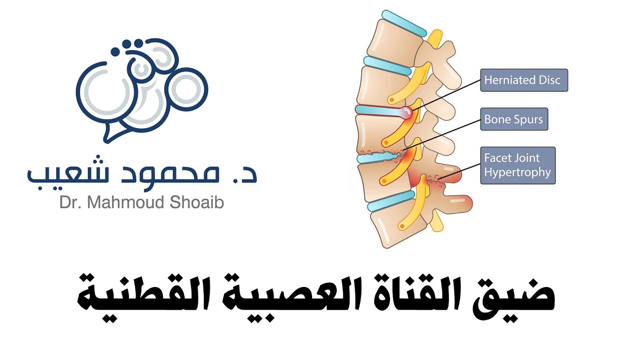 ضيق القناة العصبية القطنية - د. محمود شعيب