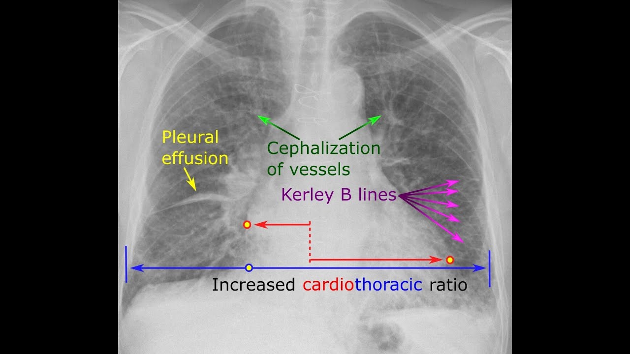 Chest X Ray in Heart failure - Dr.Rajesh Gubba