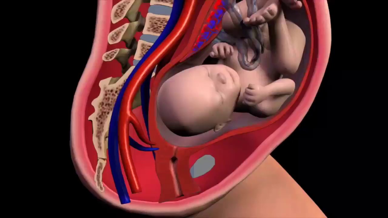 Chorioamnionitis Explained by a Lawyer #personalinjurylawyer #medicalmalpracticelawyer #shorts