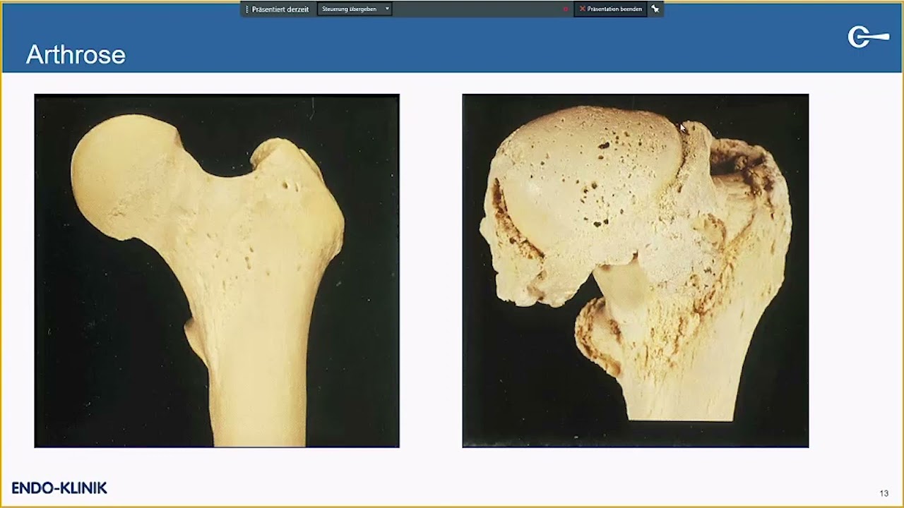 Vortrag: „Hüftarthrose – Behandlung und ENDOprothetik“ – Dr. Hans Mau, Leitender Oberarzt