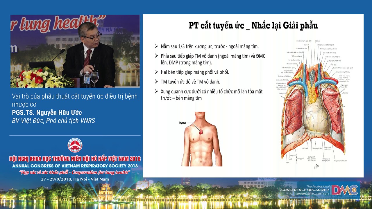 Vai trò của phẫu thuật cắt tuyến ức điều trị bệnh nhược cơ