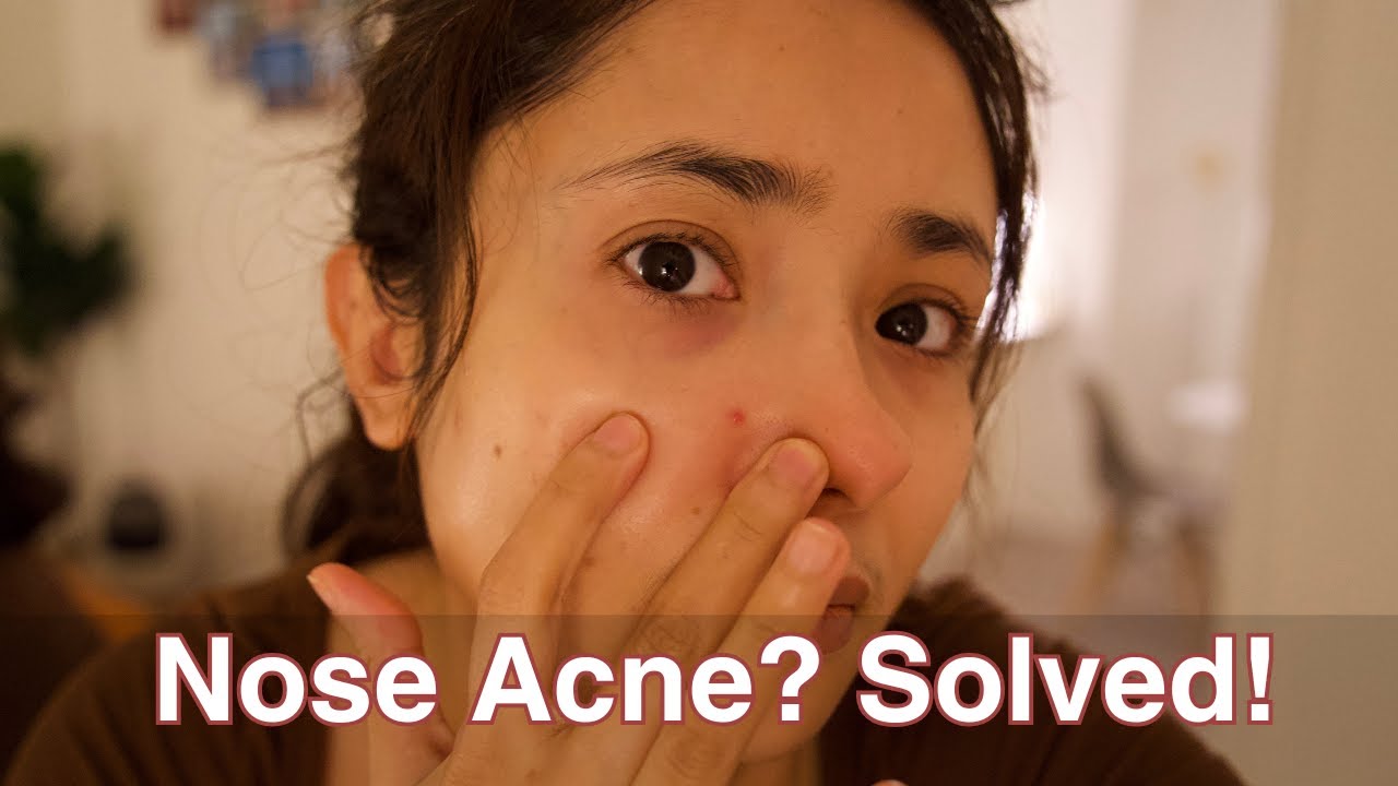 How To Get Rid of Nose Pimples in 3 Easy Ways - Skincare Specialist Tips