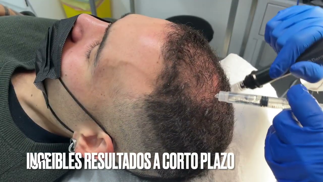 Mesoterapia para Recuperación Capilar. Clínica Merced 👩‍⚕️👨‍⚕️