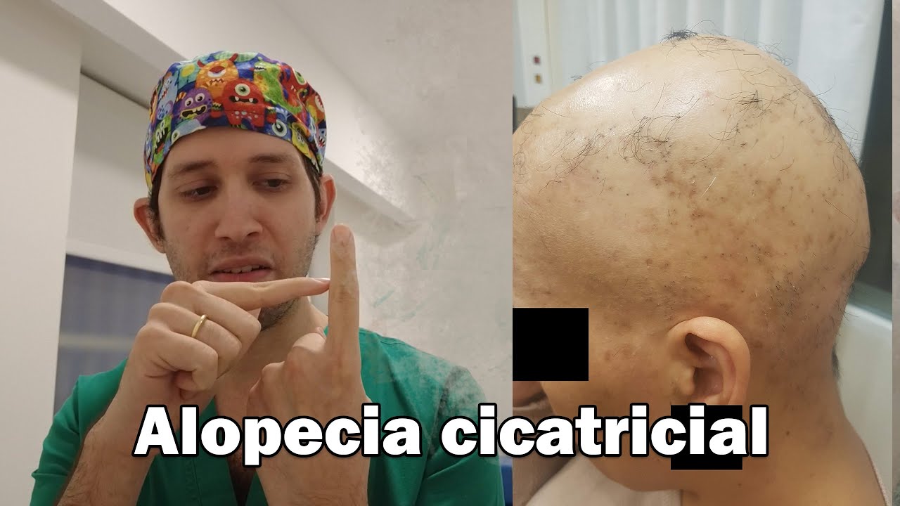 Alopecias irreversibles : nuevos avances