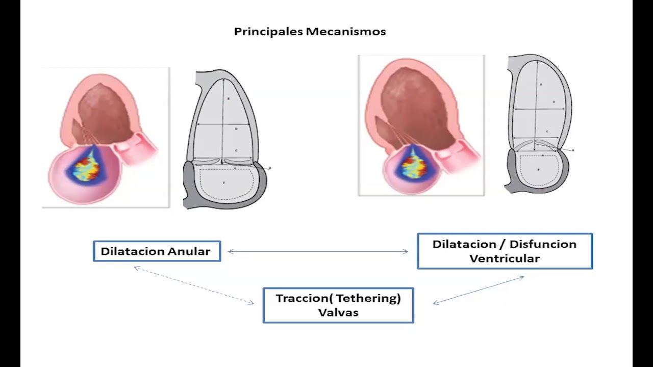 Ateneo IMedCV - Fisiopatología Insuficiencia mitral secundaria - Dr Pizarro