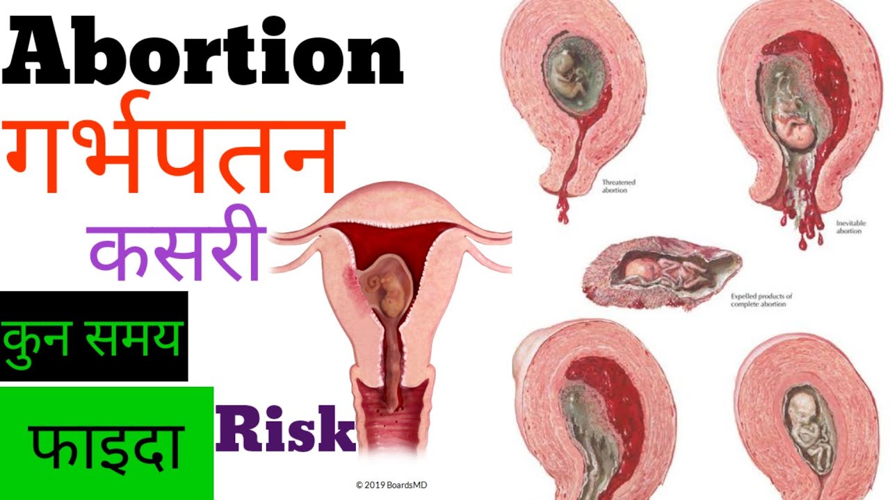 गर्भपतन || abortion || कसरी गरिन्छ || सावधानी || Risk in nepali 