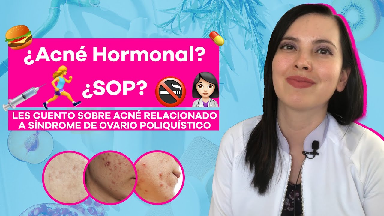 ¿Acné hormonal?  Síndrome de ovario poliquístico y piel