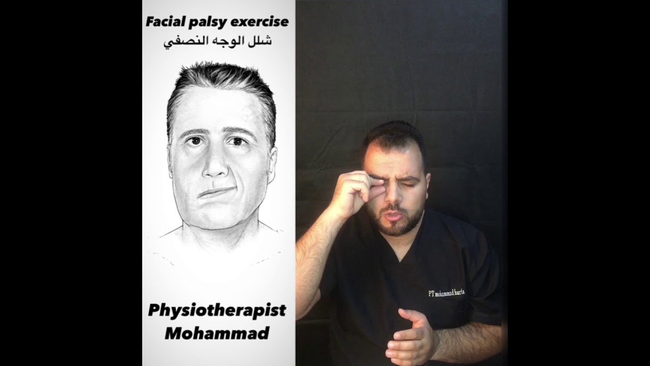 العصب السابع/facial palsy