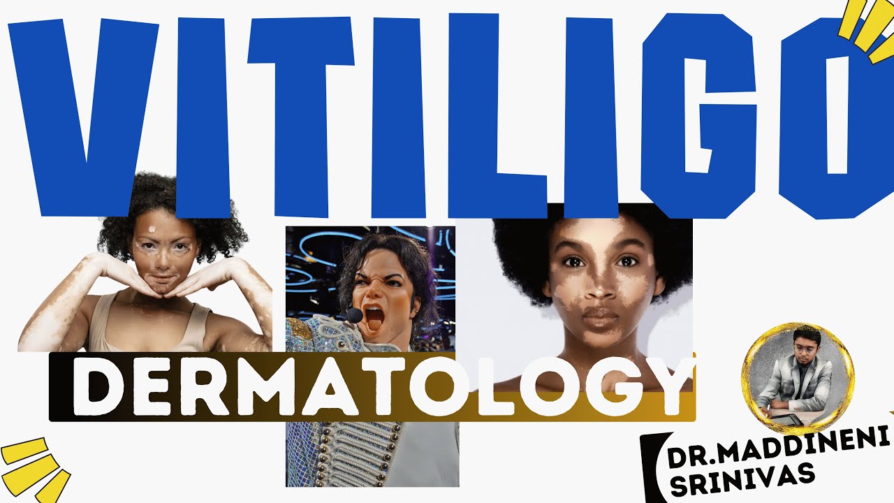 VITILIGO VULGARIS | MELANOCYTE DESTRUCTION | Dermatology lectures MBBS | Dr Maddineni Srinivas |
