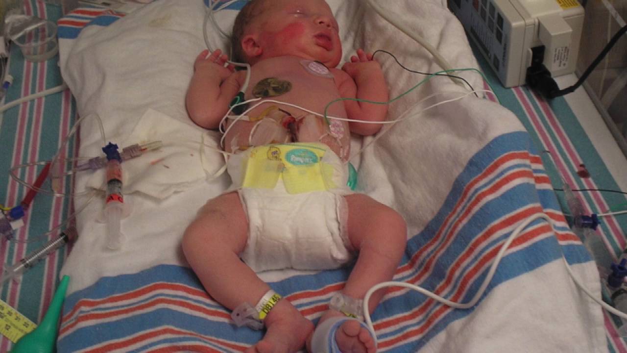 NICU Stories