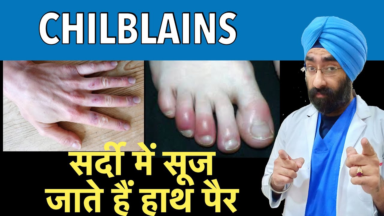 Chilblains : सर्दी में सूज जाते हैं हाथ पैर | Swollen hands and fingers in Winter | Dr.Education
