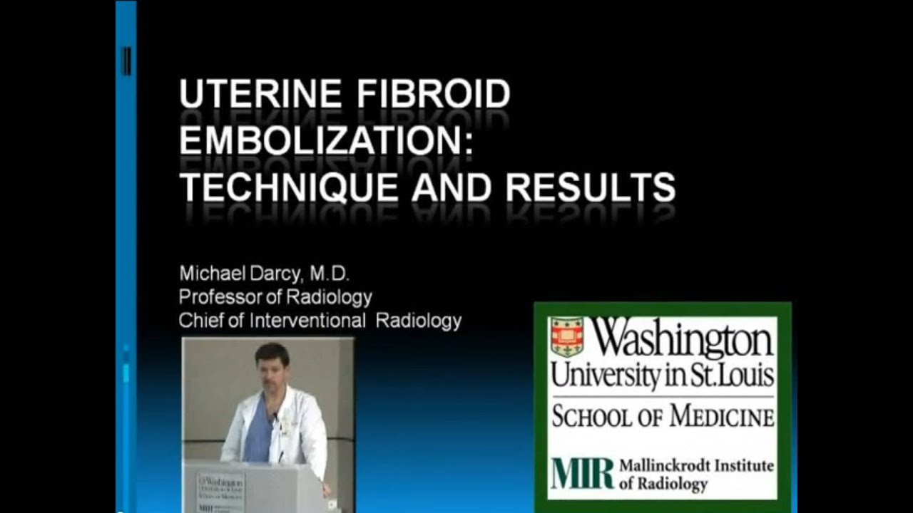 Uterine Fibroid Embolization: Technique and Results