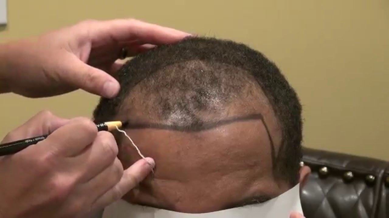 Recreating Black Male Hairline with FUE Hair Transplant Surgery Dr. Diep www.mhtaclinic.com