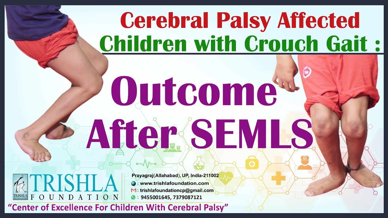 Cerebral Palsy Affected Children with Crouch Gait : Outcome After SEMLS | Trishla Foundation