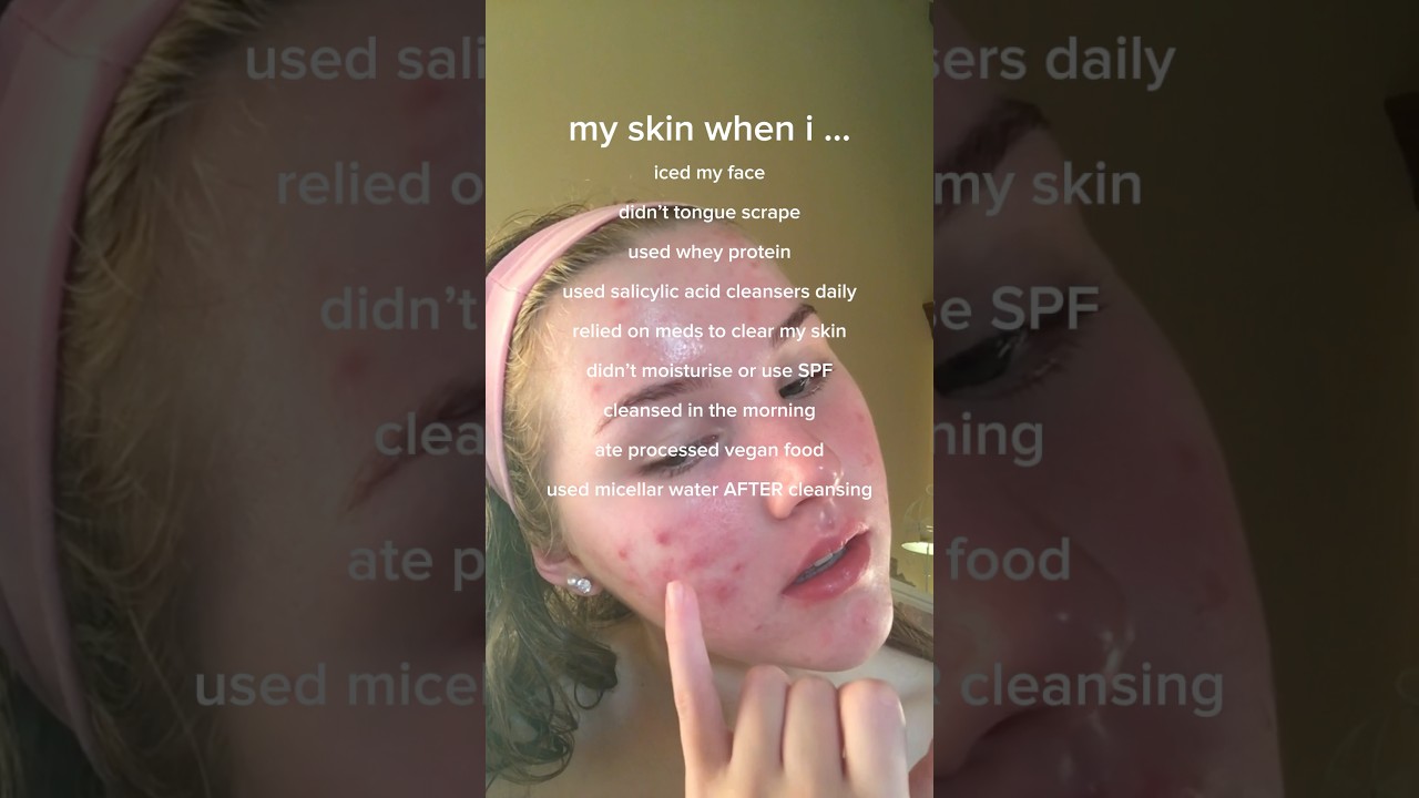 how I cleared my #ACNE