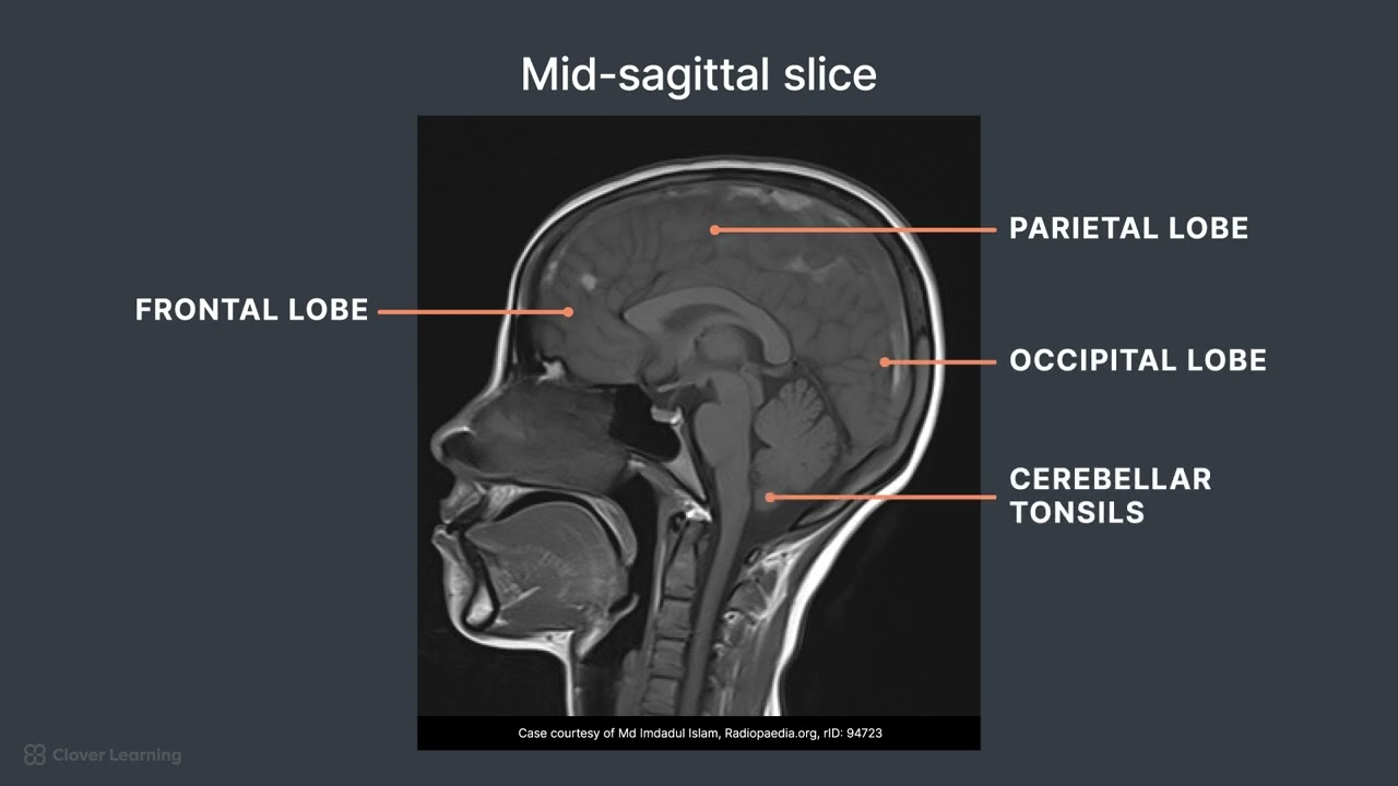 MRI Cross Sectional Anatomy of the Brain (Sagittal View)
