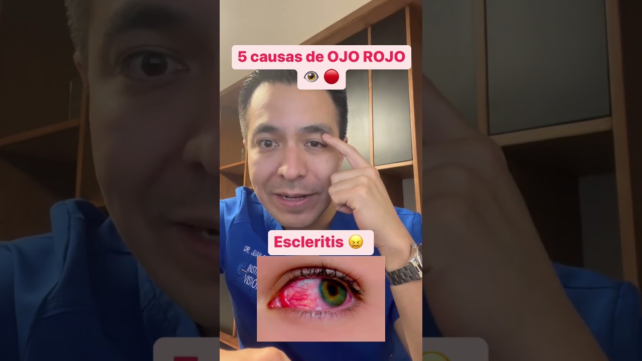 Comparte 🙏🏻. 5 causas de ojo rojo 👁️ 🔴. Escribe parte 2 si quieres saber el tratamiento.