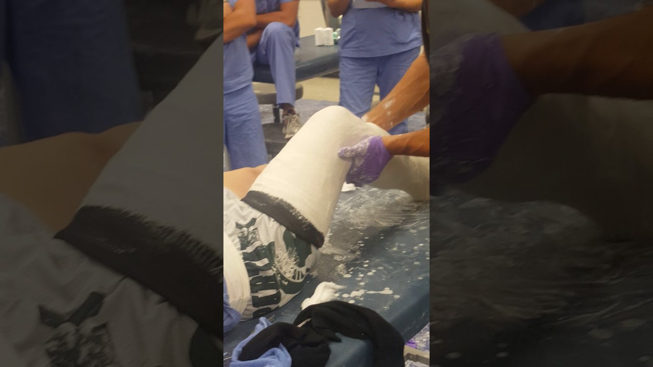 Long leg cast 2
