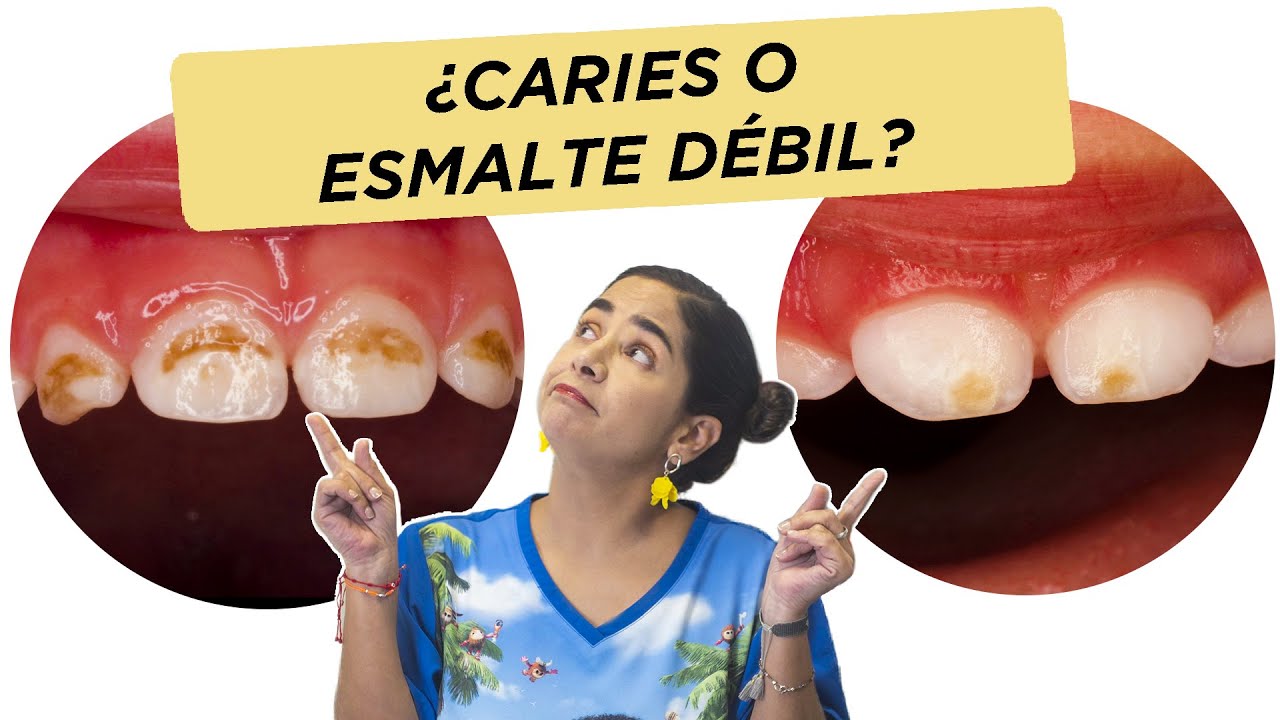 ¿Es caries o esmalte débil?