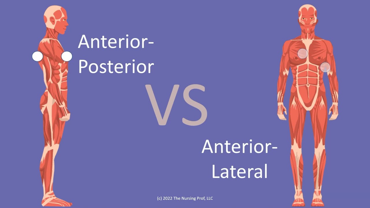 Cardioversion Pad Placement