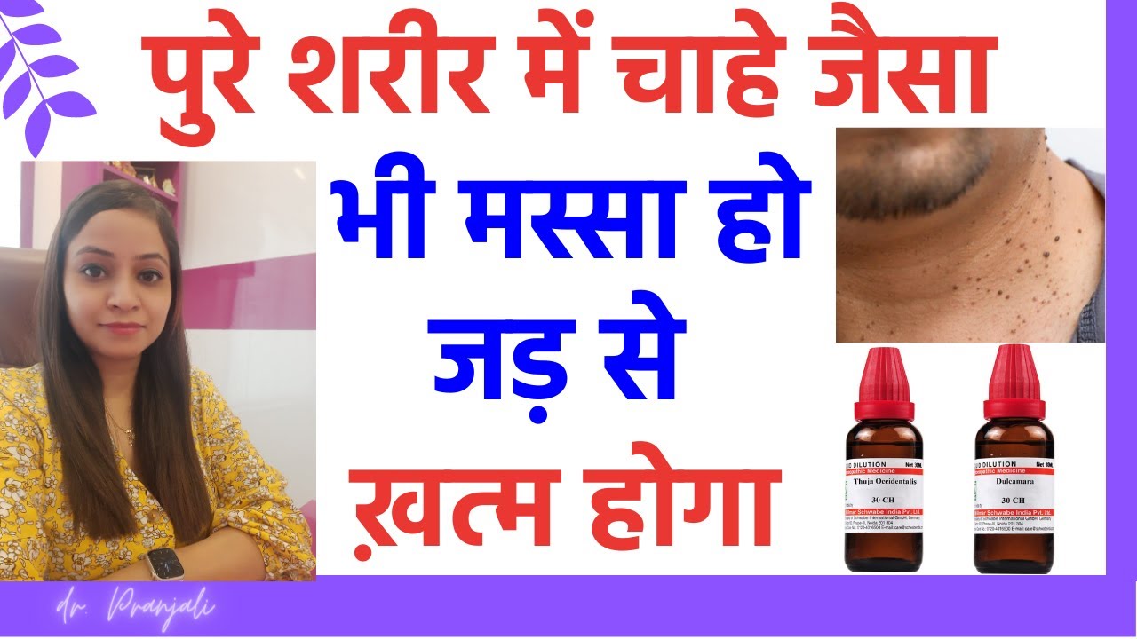 मस्से का इलाज | मस्से को जड़ से हटाने के उपाय | masse hatane ki homeopathic medicine | warts ka ilaj