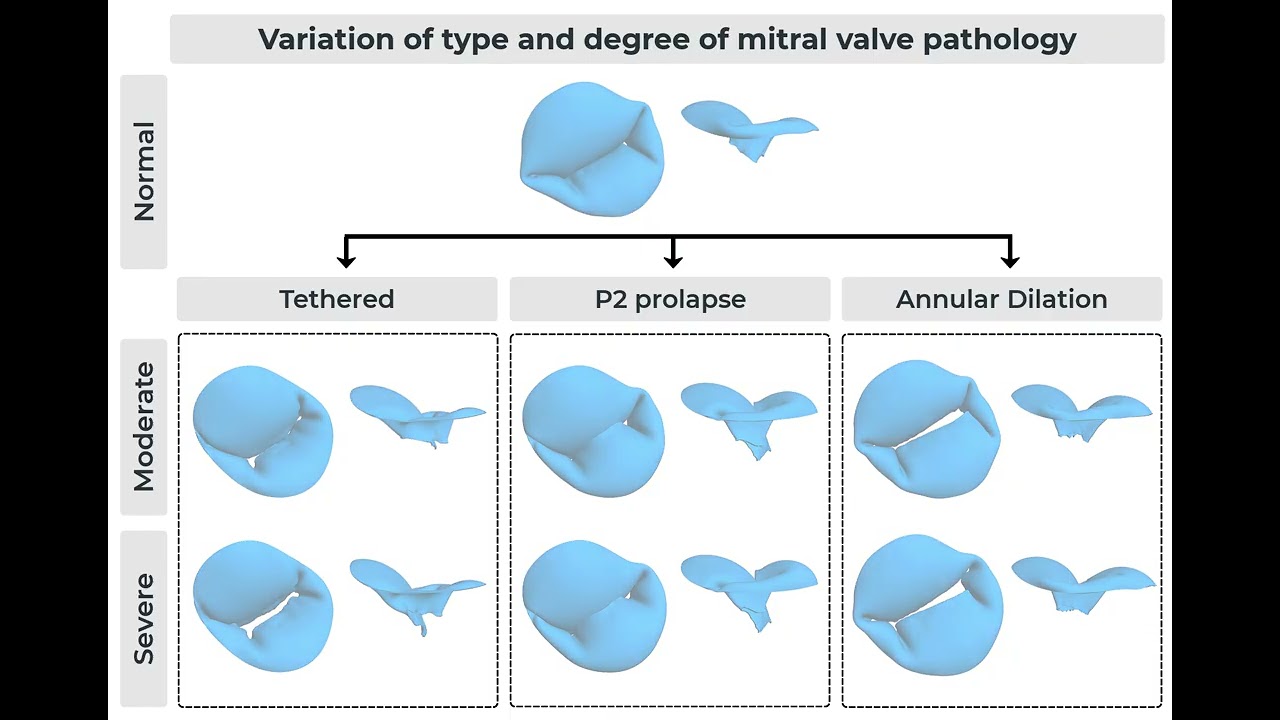 Variation of Type and Degree of Mitral Valve Pathology