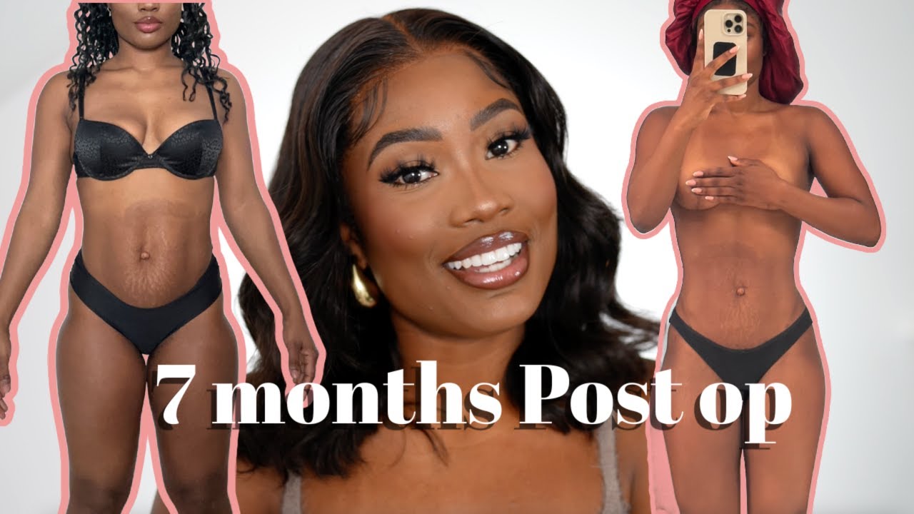 7 MONTH POST OP - I GOT MORE WORK DONE?! WHAT I'VE DONE TO MAINTAIN MY BODY... THE FINAL UPDATE!
