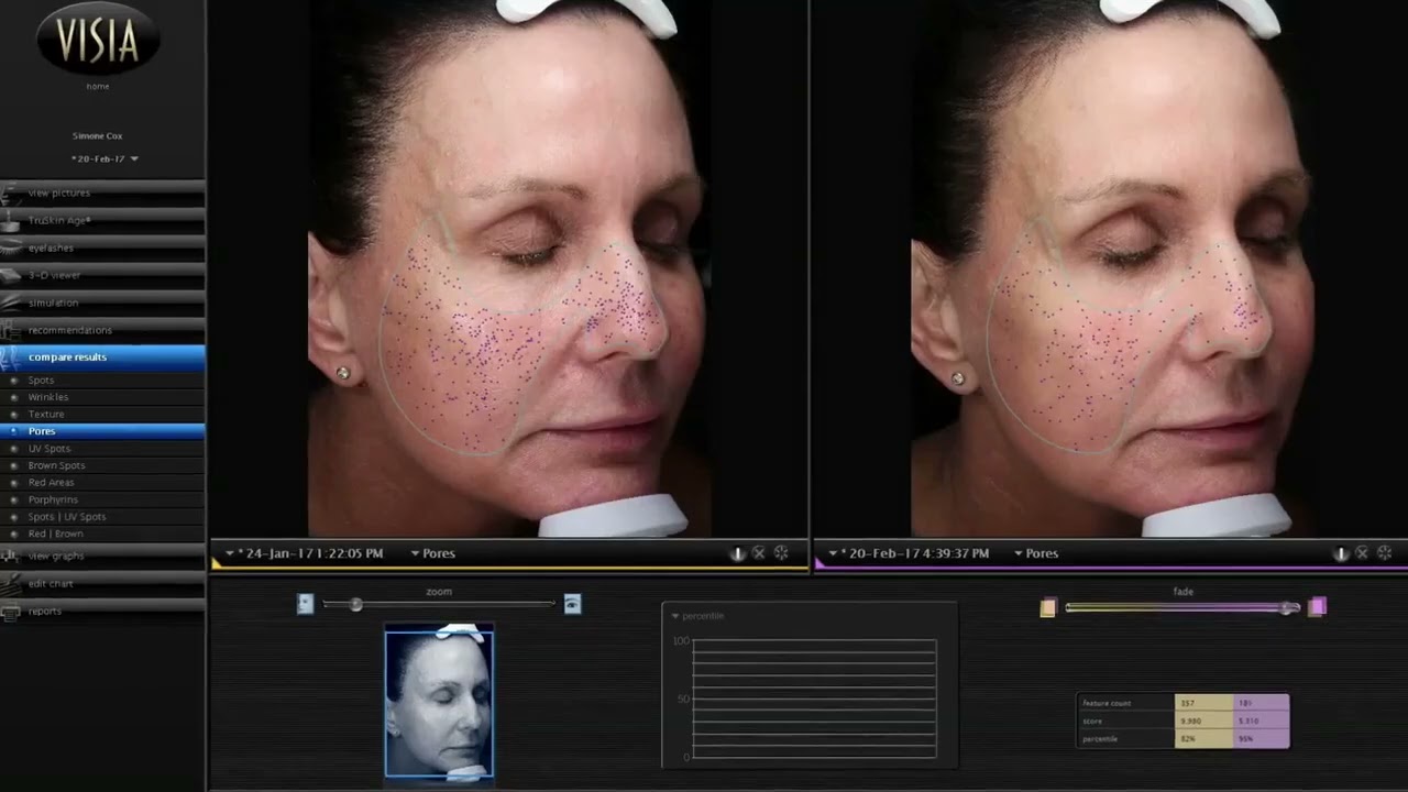 Visia Skin Analysis | Scan Tests Progression