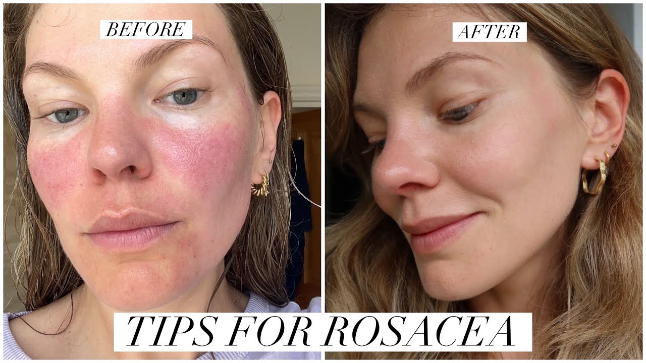Rosacea: 4 skincare products & treatments that work