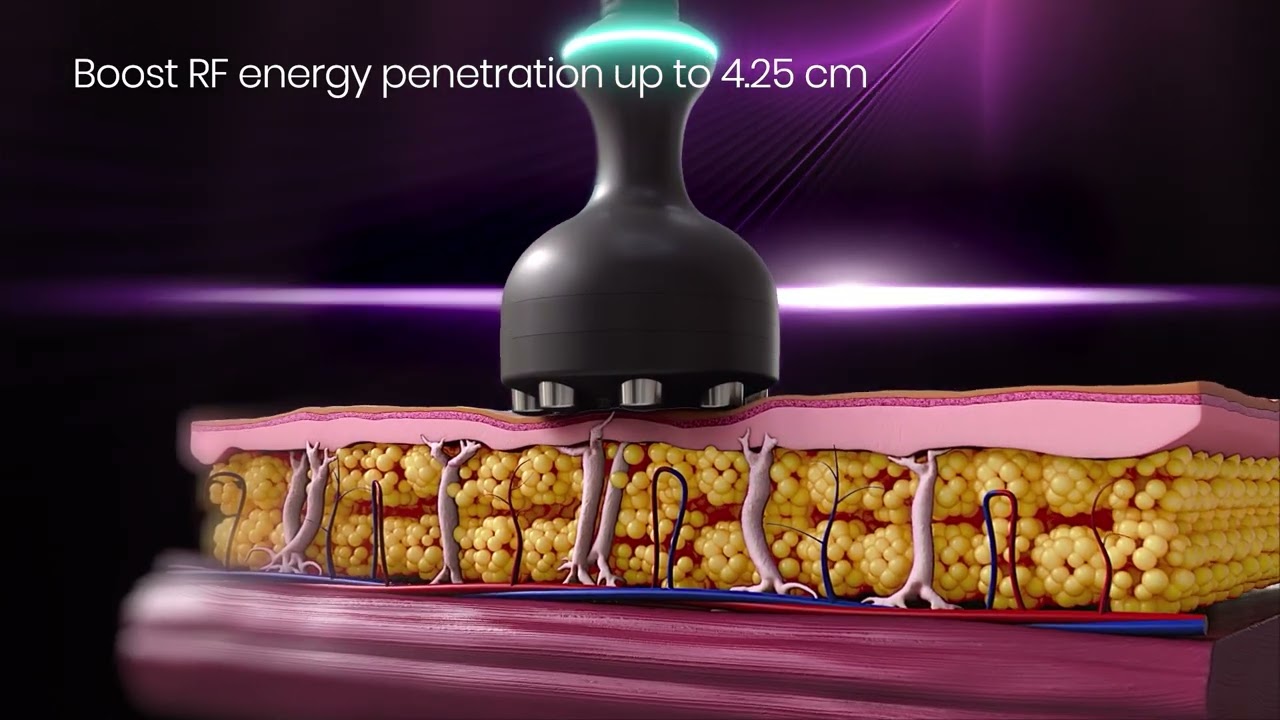 Introducing Venus Nova | Advanced Skin Rejuvenation Technology by Venus Concept