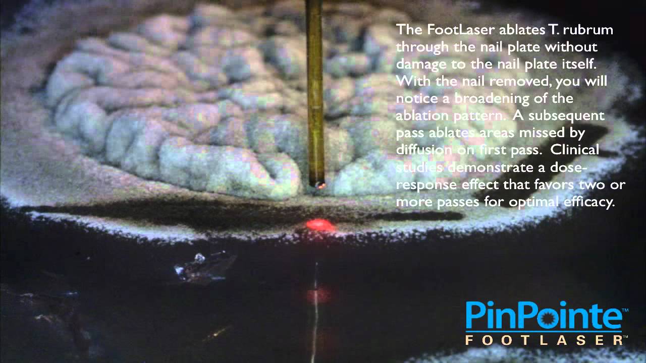 The PinPointe FootLaser Ablates Trichophyton Rubrum