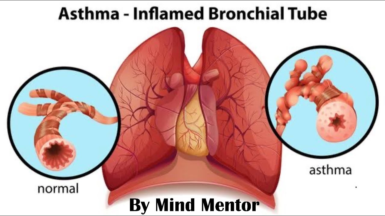 Understanding Asthma || Mild, Moderate, and Severe || Symptoms, Causes, Diagnosis and Treatment.