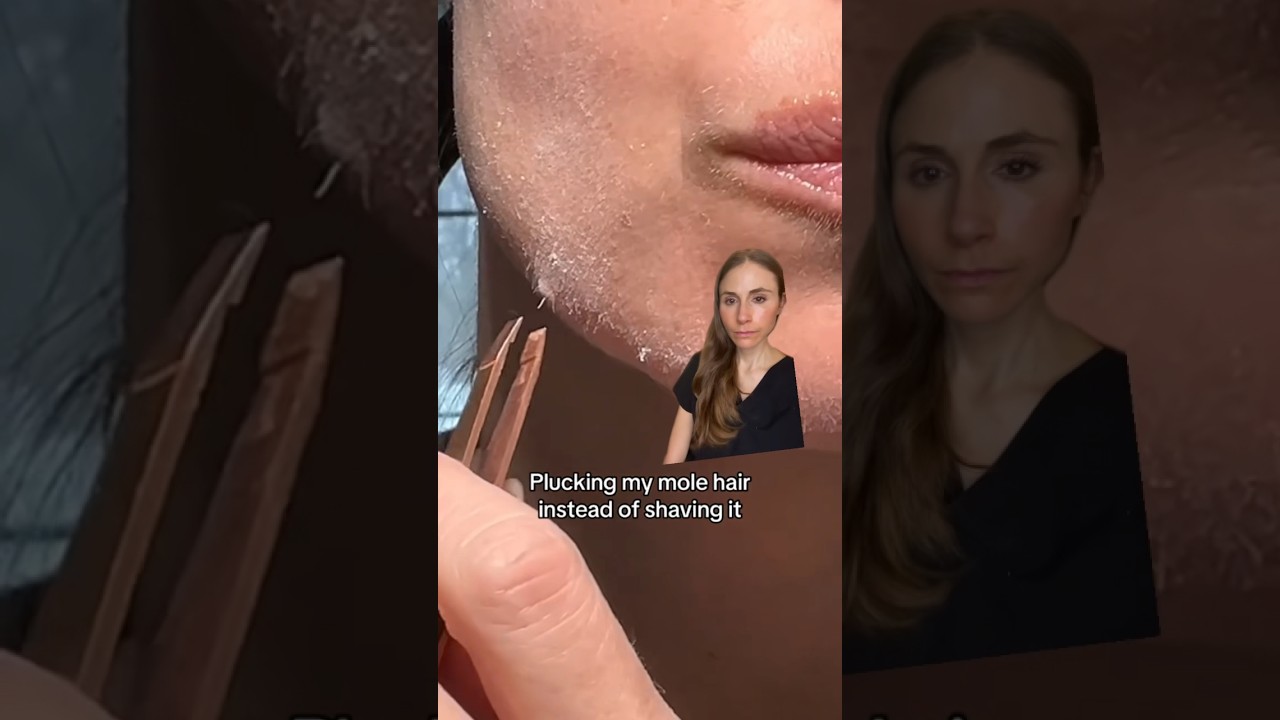 Plucking A Mole Hair #dermatologist
