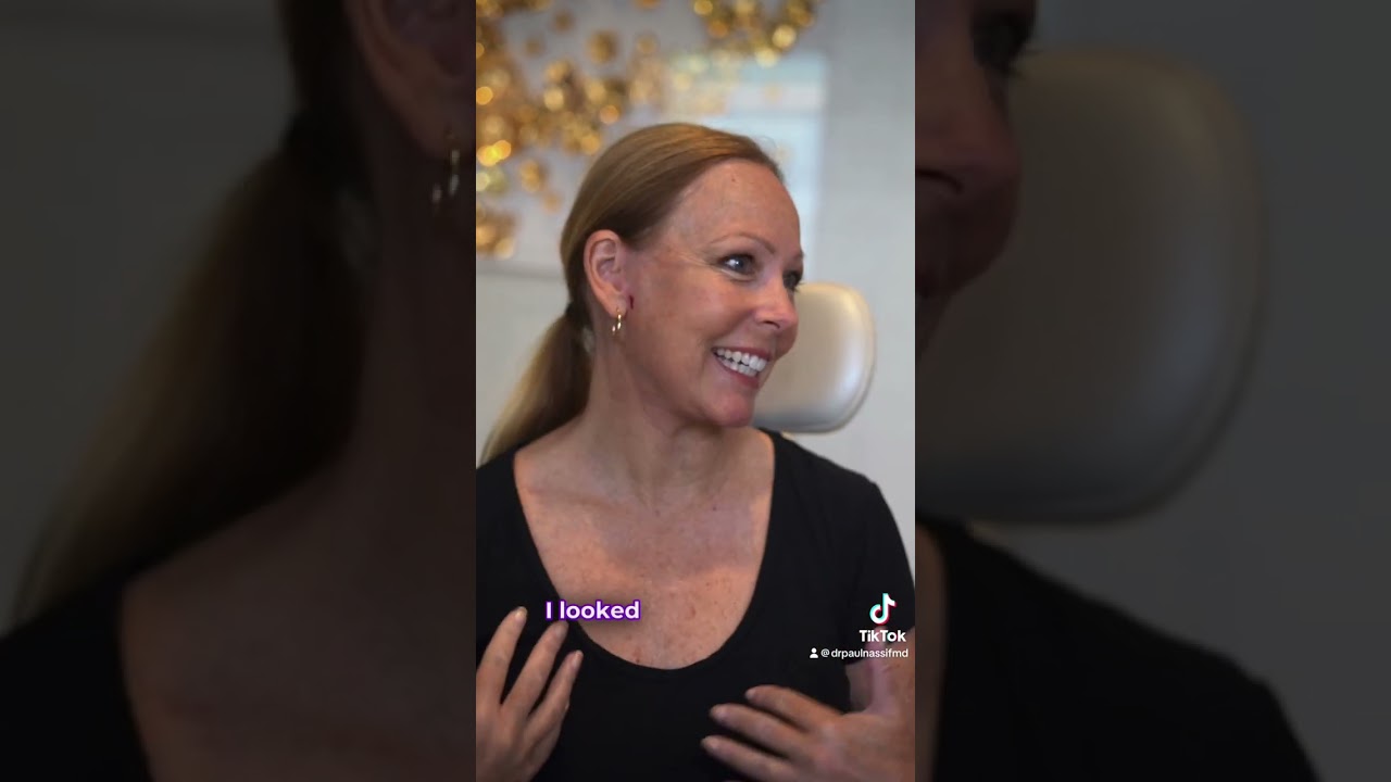 Rejuvenation Unveiled: 3-Month Transformation After Face and Neck Lift