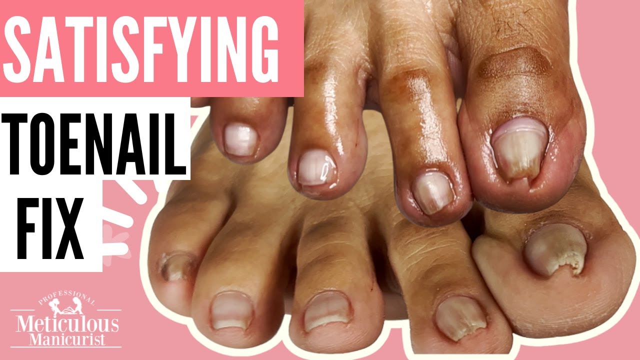 Ultimate Toenail Cleaning | Deeply Relaxing Pedicure No Talking