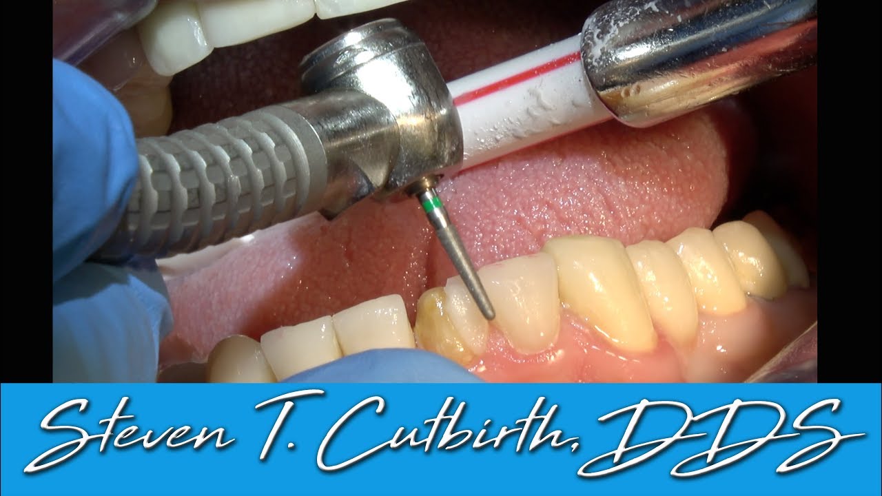 Replacement and Provisionalization of a Single Porcelain Veneer