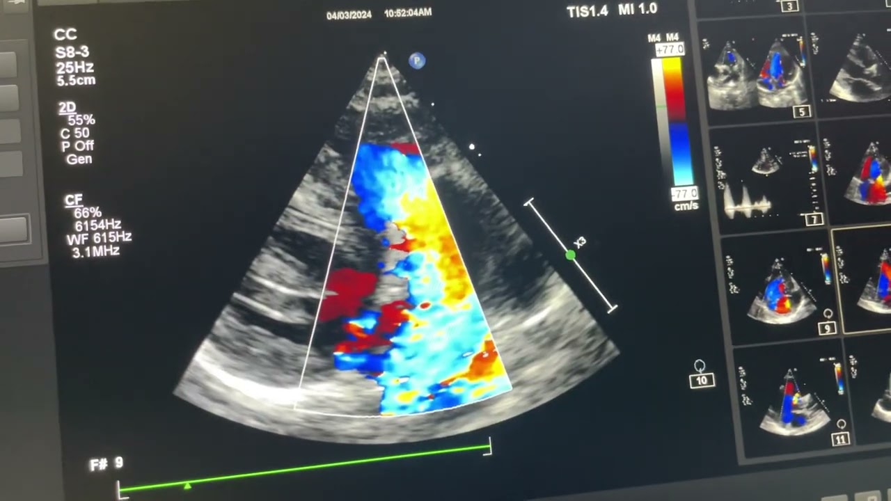 PM VSD, how to differentiate from outlet supracristal VSD