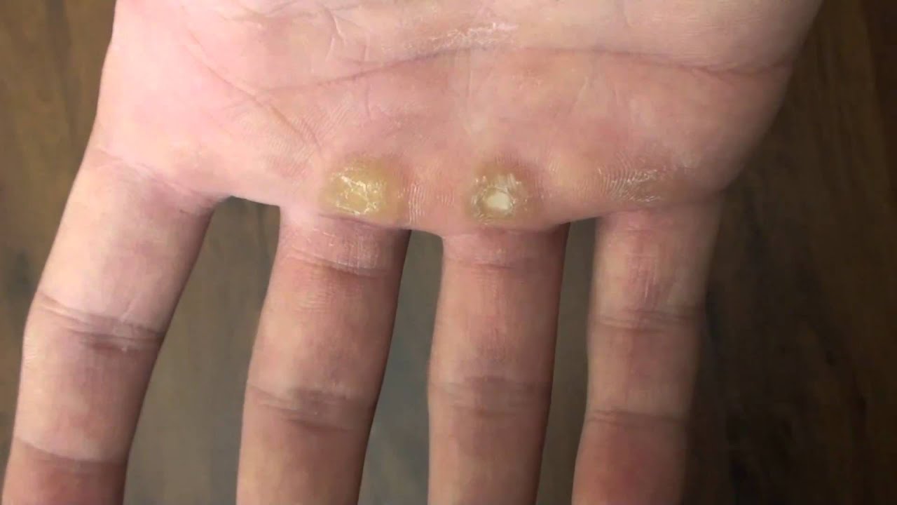 Callus Removal